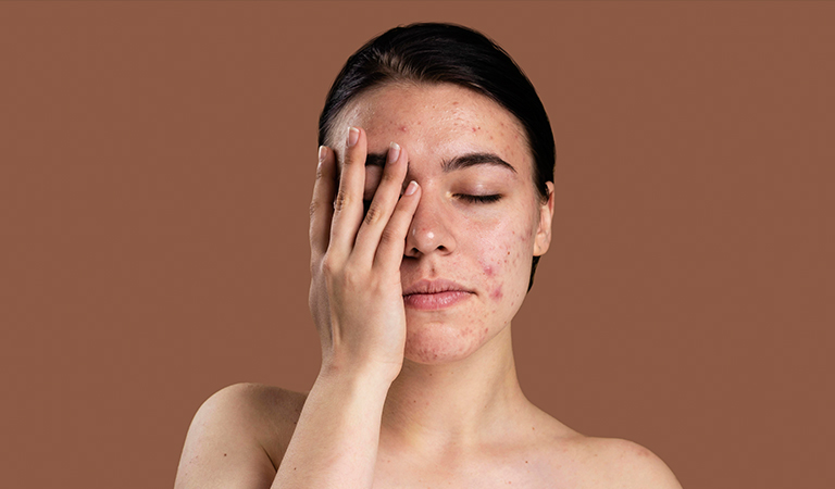 Skin Problems Acupressure Treatment clinic in Delhi