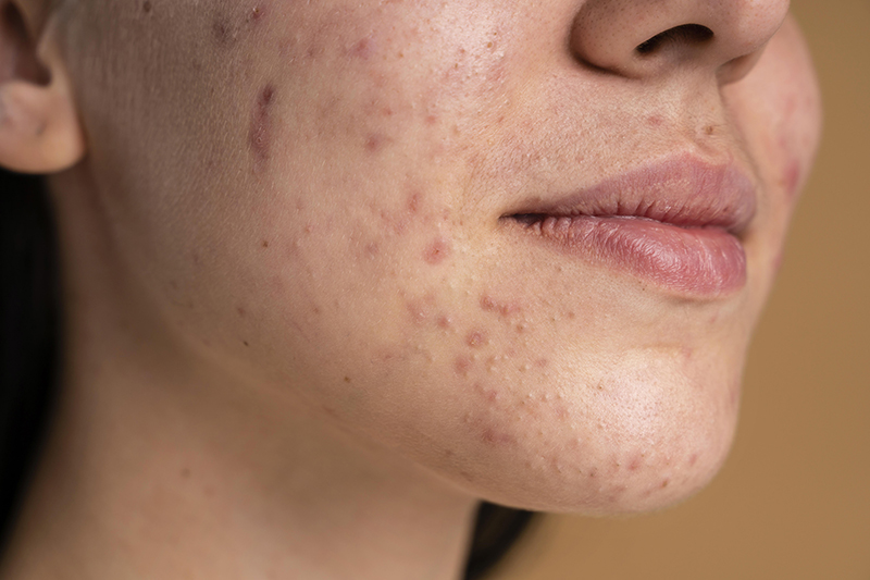 acne acupressure treatment clinic in Delhi